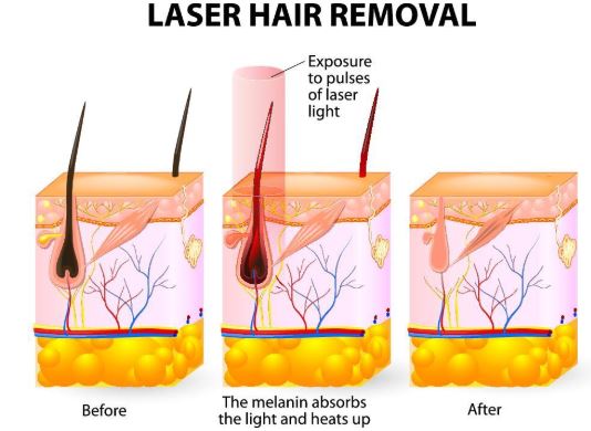 laser hiar removal